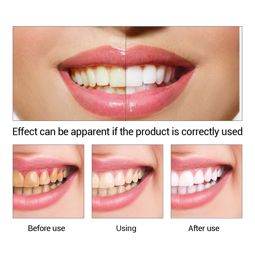 FTEENPLY Teeth Whitening Essen - Teeth Whitening Results review and price