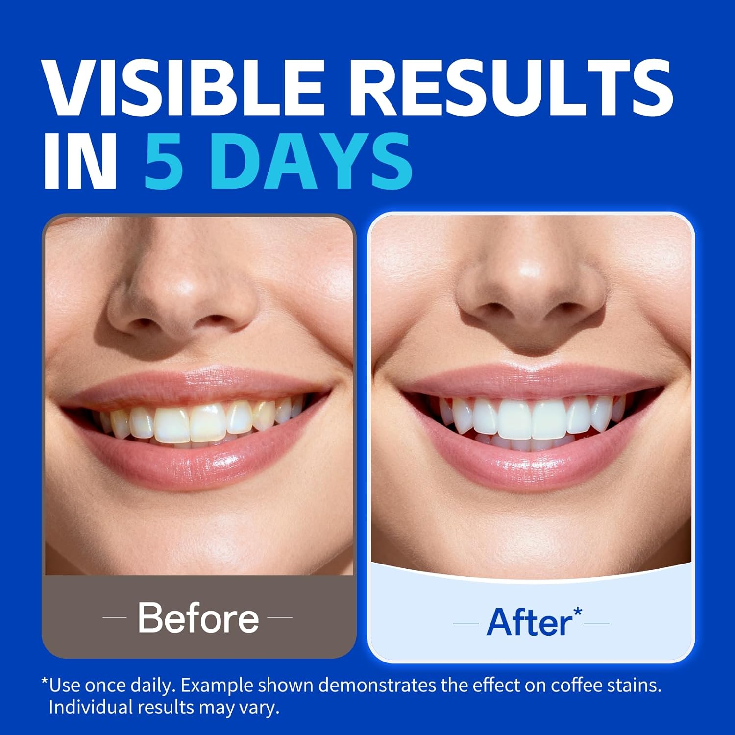 1/7 pairs Teeth Whitening Stri - Teeth Whitening Retainer review and price